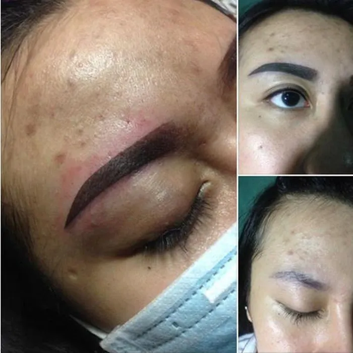 chân mày hư do mực