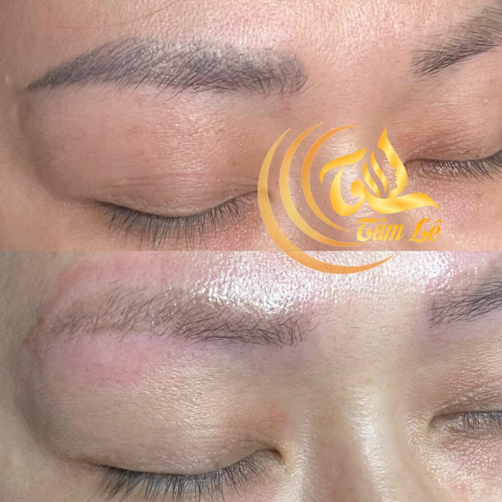 xóa chân mày bị hư