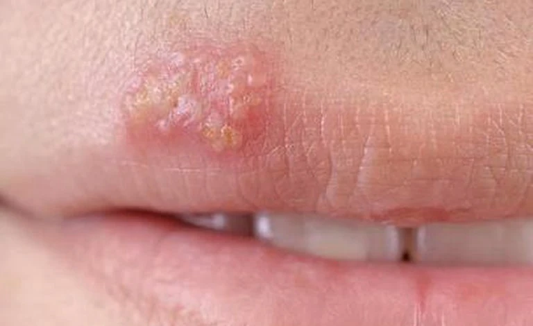 Phun môi bị mụn nước bao lâu thì khỏi